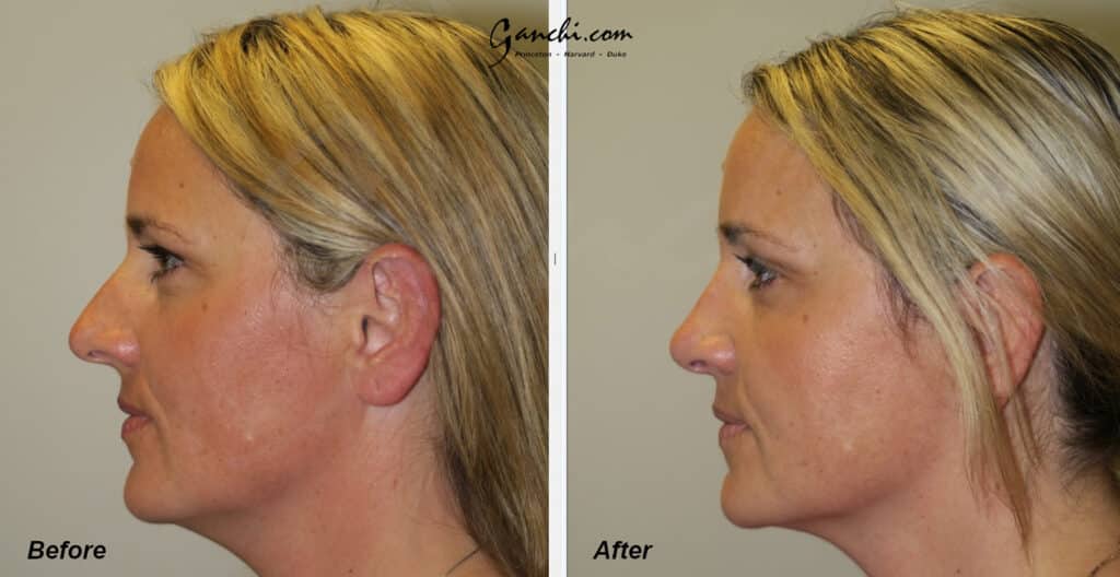 Rhinoplasty Before and After Photo by Ganchi Plastic Surgery in Northern New Jersey