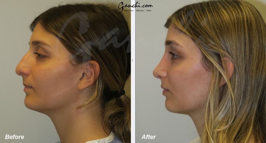 Rhinoplasty Before and After Photo by Ganchi Plastic Surgery in Northern New Jersey