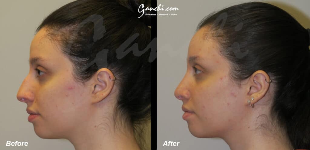 Rhinoplasty Before and After Photo by Ganchi Plastic Surgery in Northern New Jersey