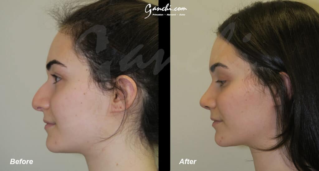 Rhinoplasty Before and After Photo by Ganchi Plastic Surgery in Northern New Jersey
