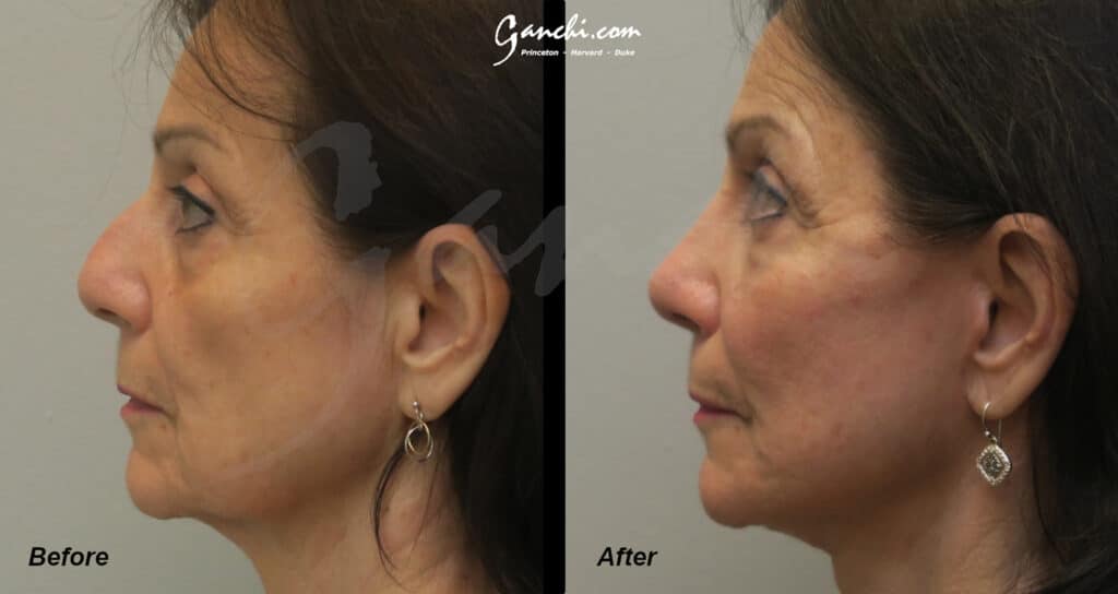 Rhinoplasty Before and After Photo by Ganchi Plastic Surgery in Northern New Jersey