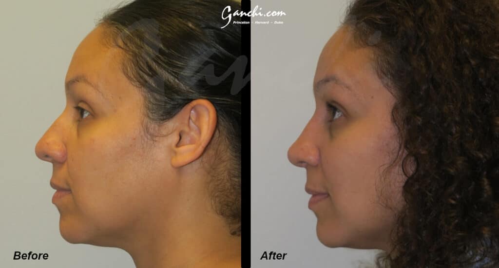 Rhinoplasty Before and After Photo by Ganchi Plastic Surgery in Northern New Jersey