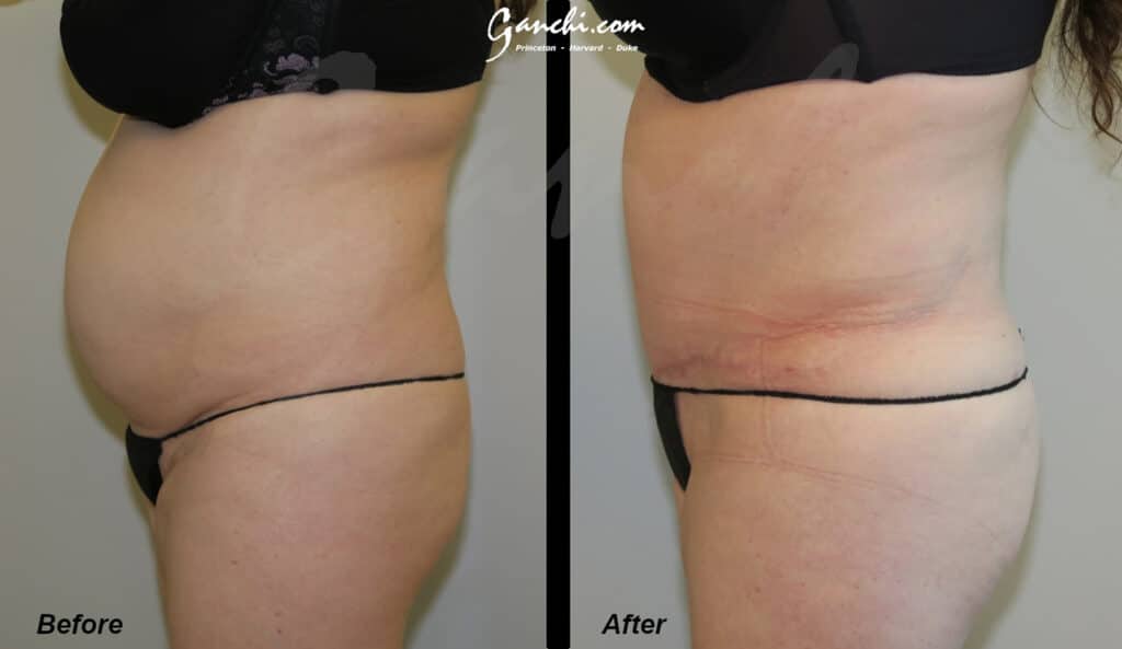 Tummy Tuck Before and After Photo by Ganchi Plastic Surgery in Northern New Jersey