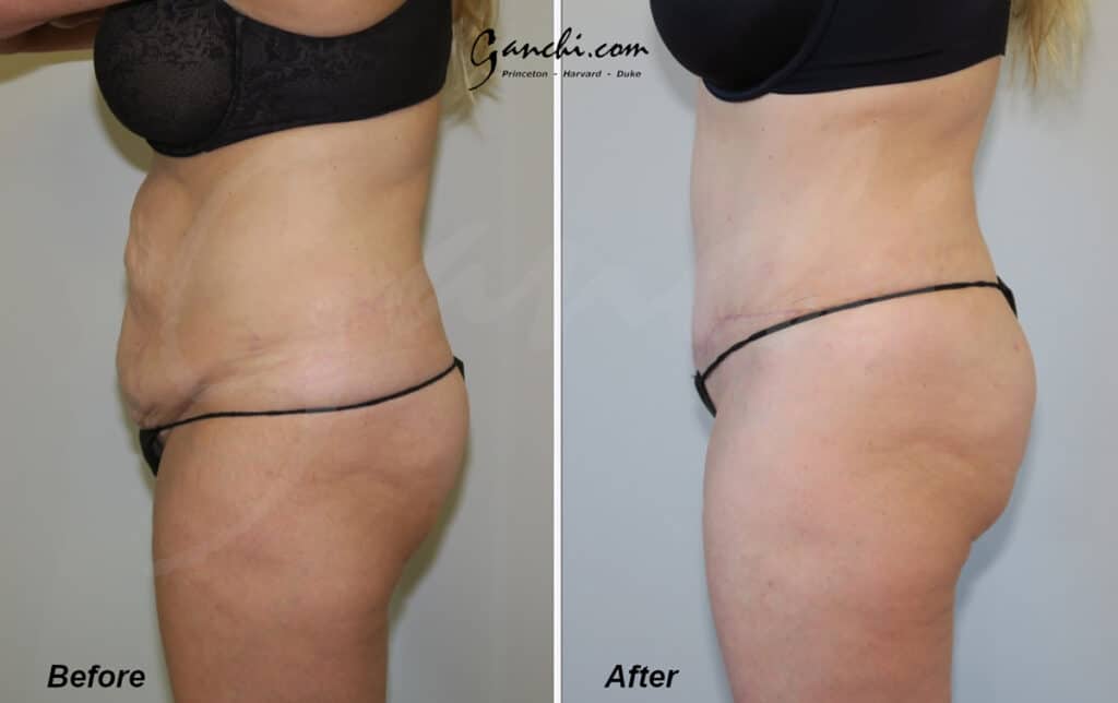 Tummy Tuck Before and After Photo by Ganchi Plastic Surgery in Northern New Jersey