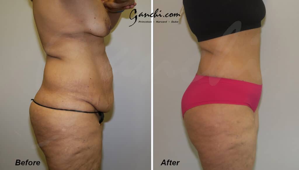 Tummy Tuck Before and After Photo by Ganchi Plastic Surgery in Northern New Jersey