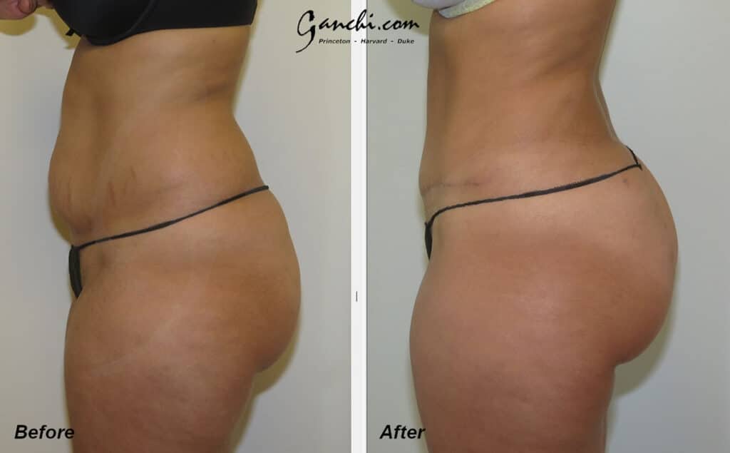 Abdominoplasty:Liposuction Before and After Photo by Ganchi Plastic Surgery in Northern New Jersey