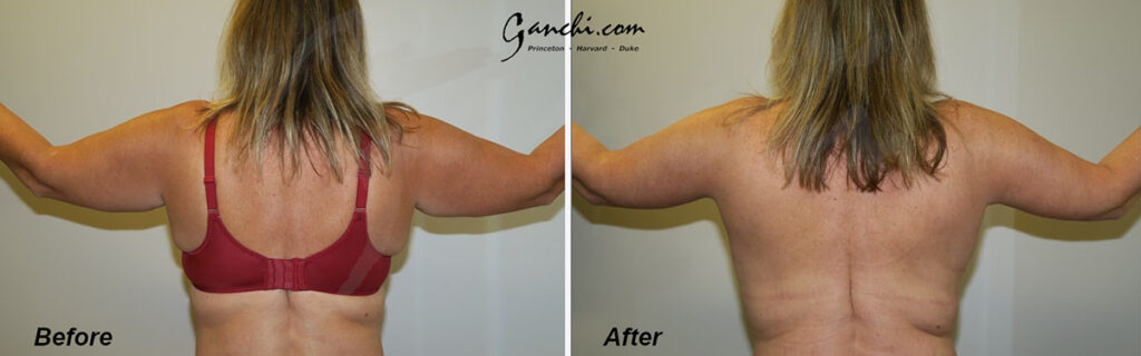 Arm Lift Before and After Photo by Ganchi Plastic Surgery in Northern New Jersey