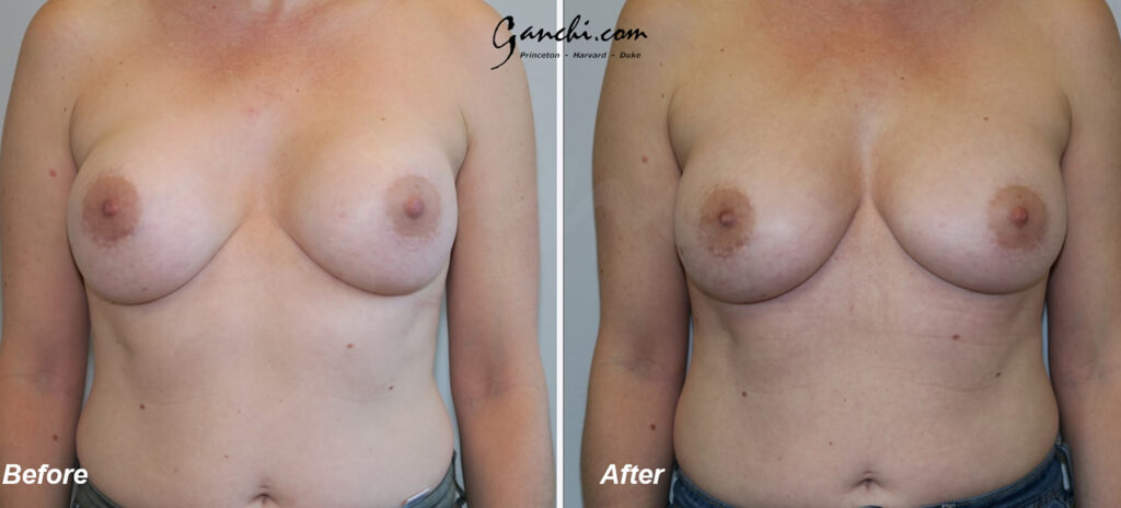 Breast Implant Before and After Photo by Ganchi Plastic Surgery in Northern New Jersey