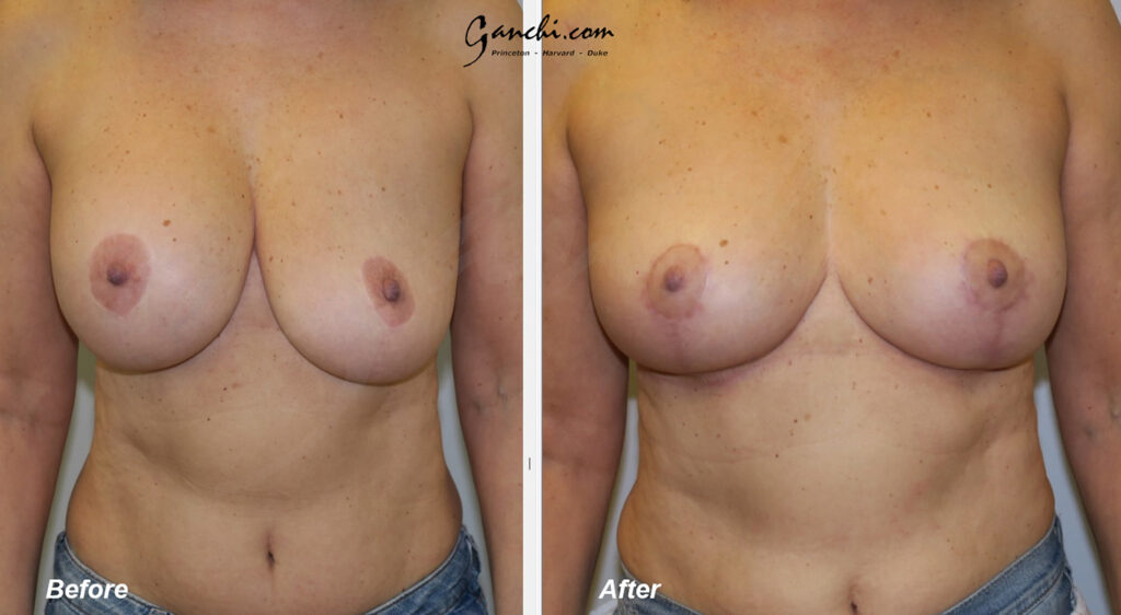 Breast Implant Before and After Photo by Ganchi Plastic Surgery in Northern New Jersey