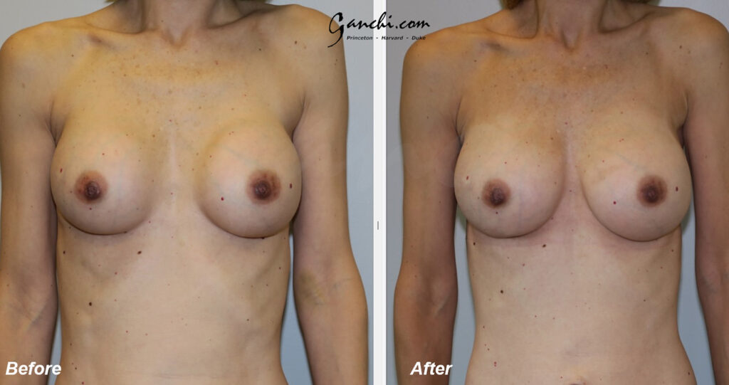 Breast Implant Before and After Photo by Ganchi Plastic Surgery in Northern New Jersey