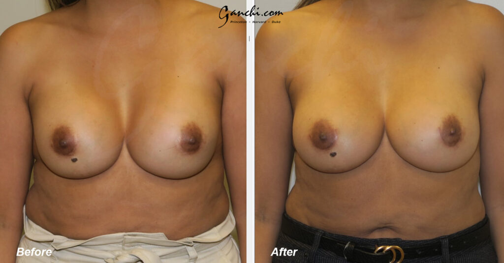 Breast Implant Before and After Photo by Ganchi Plastic Surgery in Northern New Jersey