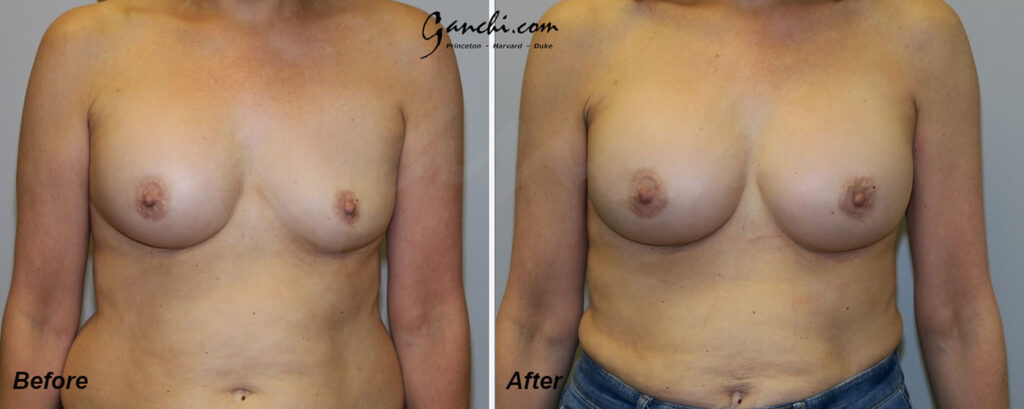 Breast Implant Revision Before and After Photo by Ganchi Plastic Surgery in Northern New Jersey