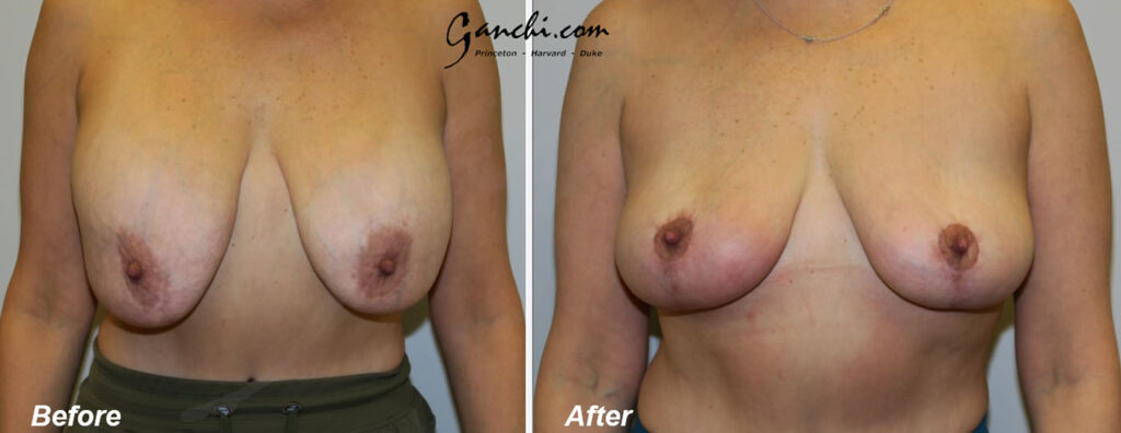 Breast Implant Revision Before and After Photo by Ganchi Plastic Surgery in Northern New Jersey