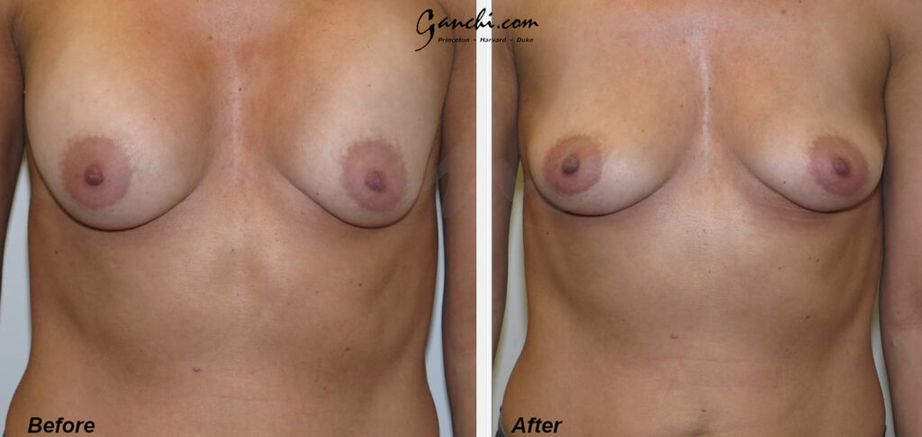 Breast Implant Revision Before and After Photo by Ganchi Plastic Surgery in Northern New Jersey