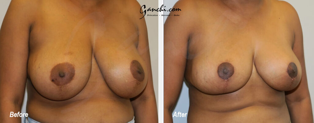 Breast Reduction Before and After Photo by Ganchi Plastic Surgery in Northern New Jersey