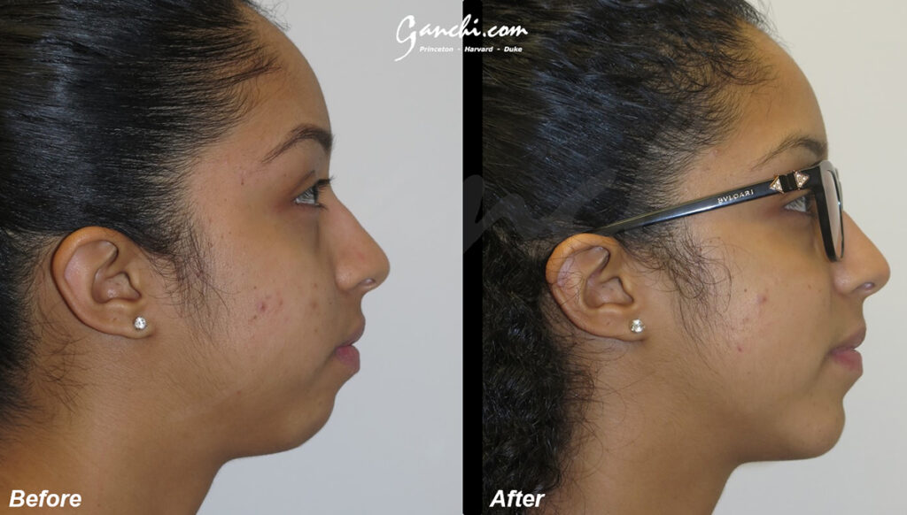 Chin Augmentation Before and After Photo by Ganchi Plastic Surgery in Northern New Jersey