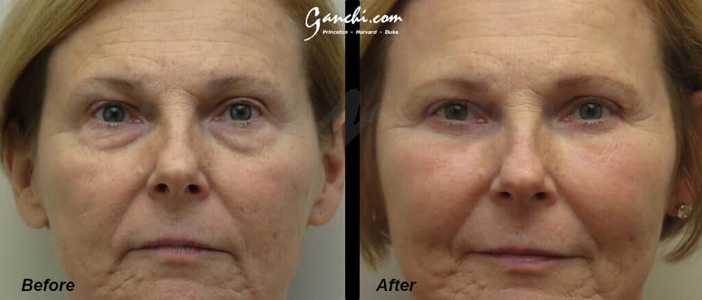 Eyelid Lift Before and After Photo by Ganchi Plastic Surgery in Northern New Jersey