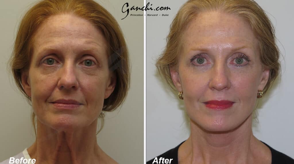 Face Neck Lift Before and After Photo by Ganchi Plastic Surgery in Northern New Jersey