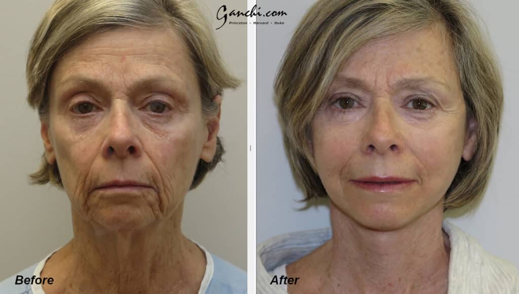 Face Neck Lift Before and After Photo by Ganchi Plastic Surgery in Northern New Jersey