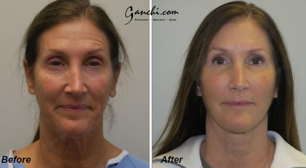 Face/Necklift Before and After Photo by Ganchi Plastic Surgery in Northern New Jersey