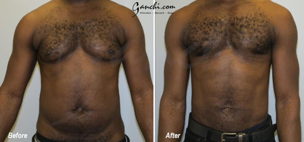 Gynecomastia Before and After Photo by Ganchi Plastic Surgery in Northern New Jersey