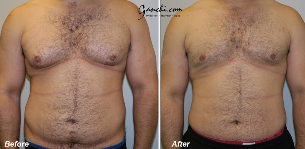 Gynecomastia:Liposuction Before and After Photo by Ganchi Plastic Surgery in Northern New Jersey
