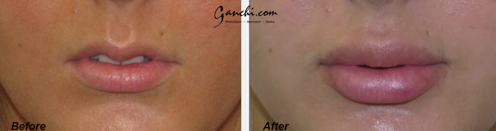 Lip Augmentation Before and After Photo by Ganchi Plastic Surgery in Northern New Jersey