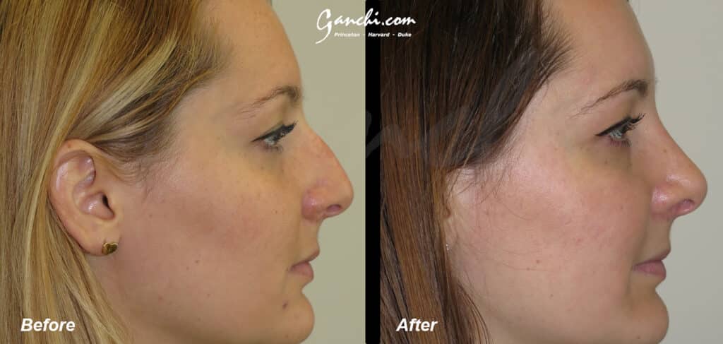 Rhinoplasty Before and After Photo by Ganchi Plastic Surgery in Northern New Jersey