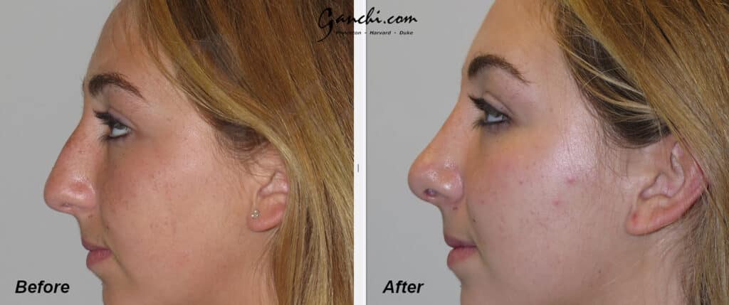 Rhinoplasty Before and After Photo by Ganchi Plastic Surgery in Northern New Jersey