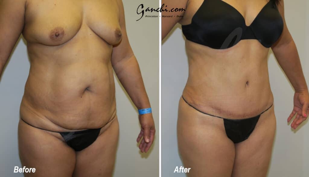 Tummy Tuck Before and After Photo by Ganchi Plastic Surgery in Northern New Jersey