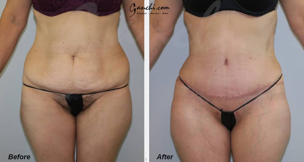 Tummy Tuck Before and After Photo by Ganchi Plastic Surgery in Northern New Jersey