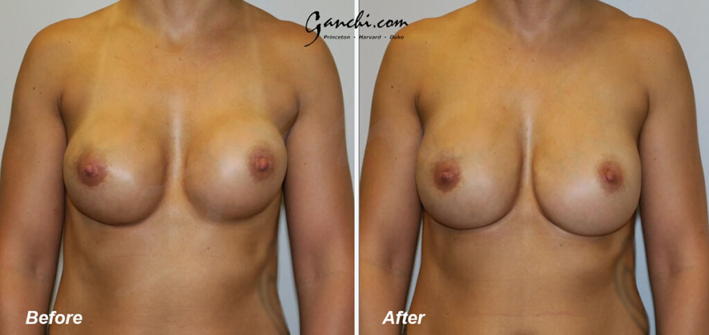 Breast Implant Revision Before and After Photo by Ganchi Plastic Surgery in Northern New Jersey