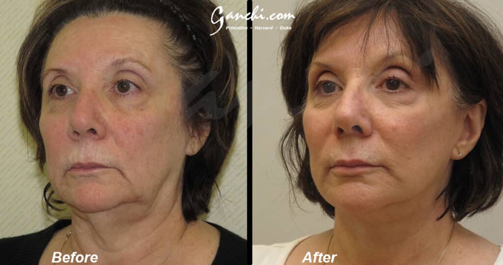Face Necklift Before and After Photo by Ganchi Plastic Surgery in Northern New Jersey