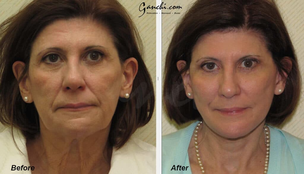 Face Necklift Before and After Photo by Ganchi Plastic Surgery in Northern New Jersey