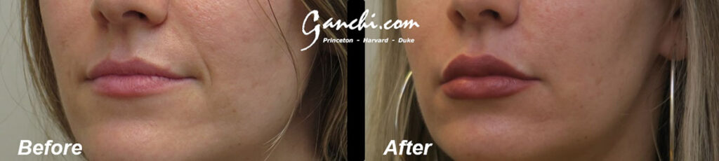 Lip Augmentation Before and After Photo by Ganchi Plastic Surgery in Northern New Jersey