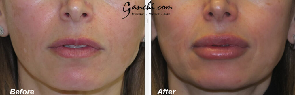 Lip Augmentation Before and After Photo by Ganchi Plastic Surgery in Northern New Jersey