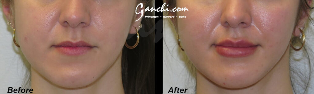 Lip Augmentation Before and After Photo by Ganchi Plastic Surgery in Northern New Jersey