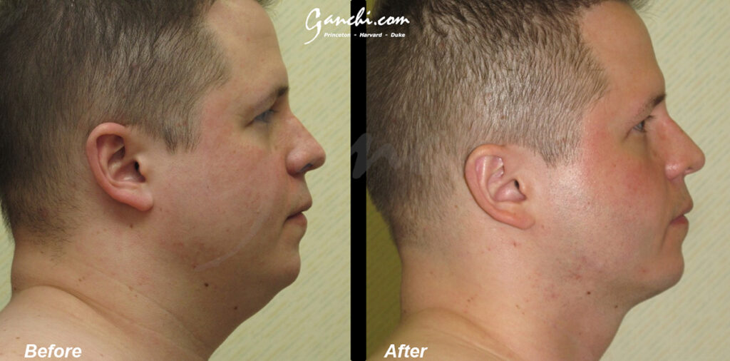 Neck Liposuction Before and After Photo by Ganchi Plastic Surgery in Northern New Jersey