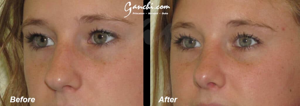 Rhinoplasty Before and After Photo by Ganchi Plastic Surgery in Northern New Jersey