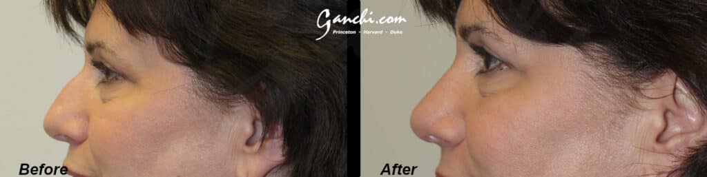 Rhinoplasty Before and After Photo by Ganchi Plastic Surgery in Northern New Jersey