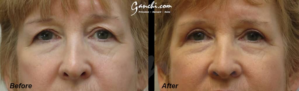 Upper Blepharoplasty Before and After Photo by Ganchi Plastic Surgery in Northern New Jersey