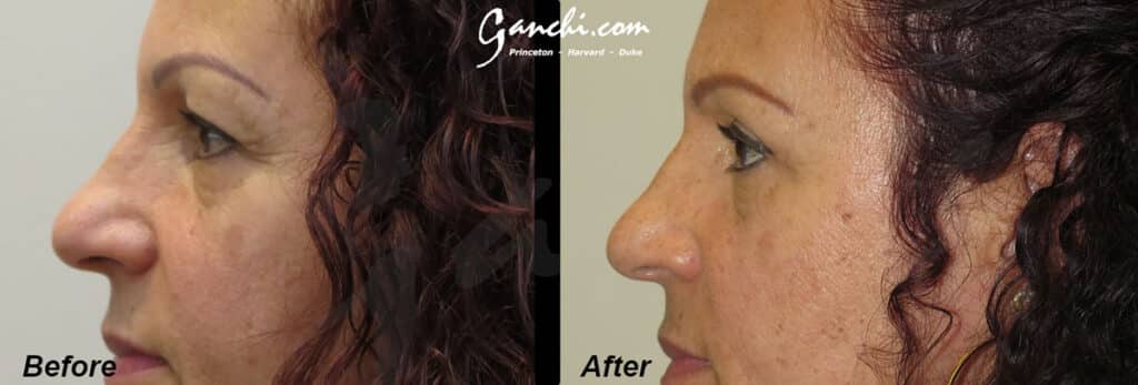 Upper Blepharoplasty Before and After Photo by Ganchi Plastic Surgery in Northern New Jersey