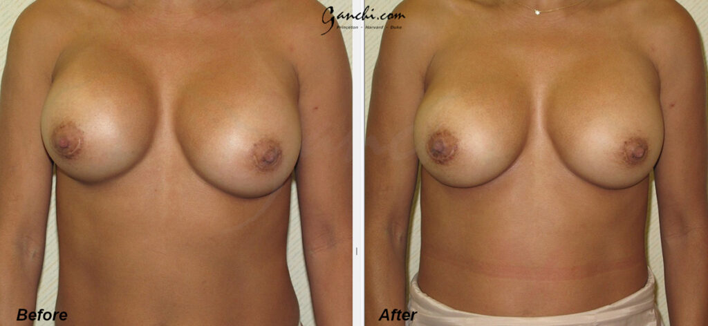 Breast Implant Revision Before and After Photo by Ganchi Plastic Surgery in Northern New Jersey