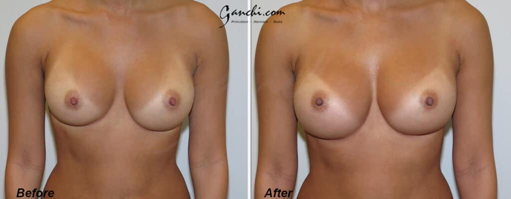 Breast Implant Revision Before and After Photo by Ganchi Plastic Surgery in Northern New Jersey