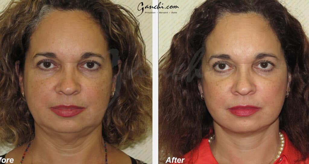 Face Necklift Before and After Photo by Ganchi Plastic Surgery in Northern New Jersey