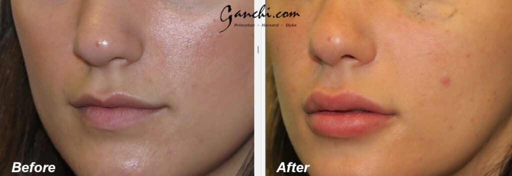 Lip Augmenation Before and After Photo by Ganchi Plastic Surgery in Northern New Jersey