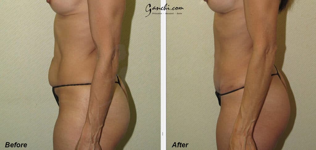Tummy Tuck Before and After Photo by Ganchi Plastic Surgery in Northern New Jersey