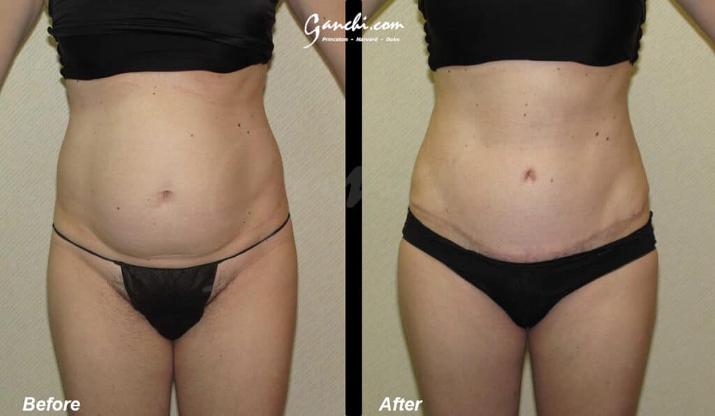Tummy Tuck Before and After Photo by Ganchi Plastic Surgery in Northern New Jersey