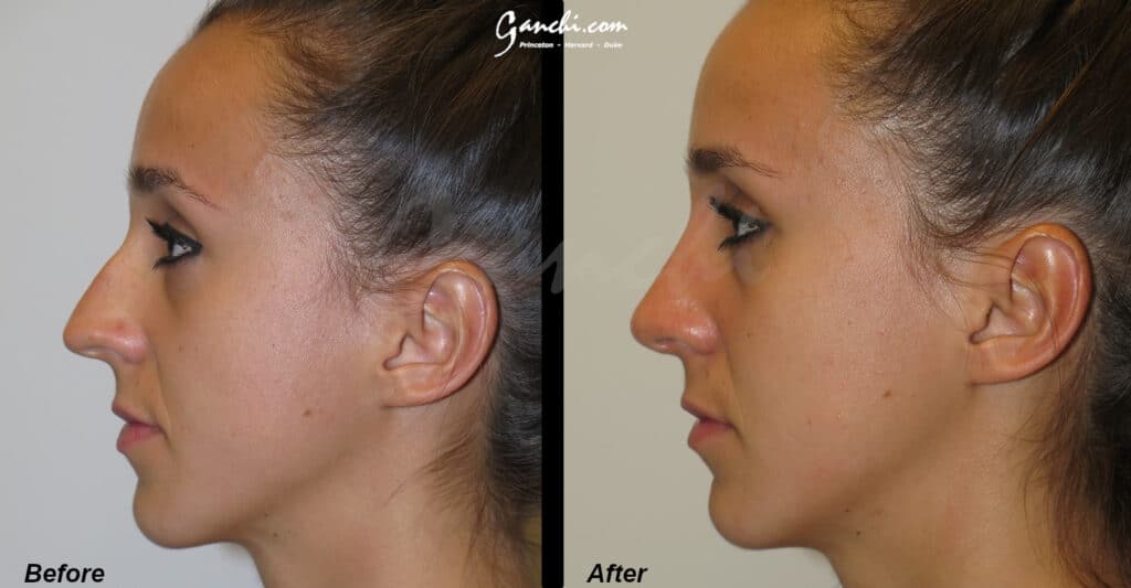 Rhinoplasty Before and After Photo by Ganchi Plastic Surgery in Northern New Jersey