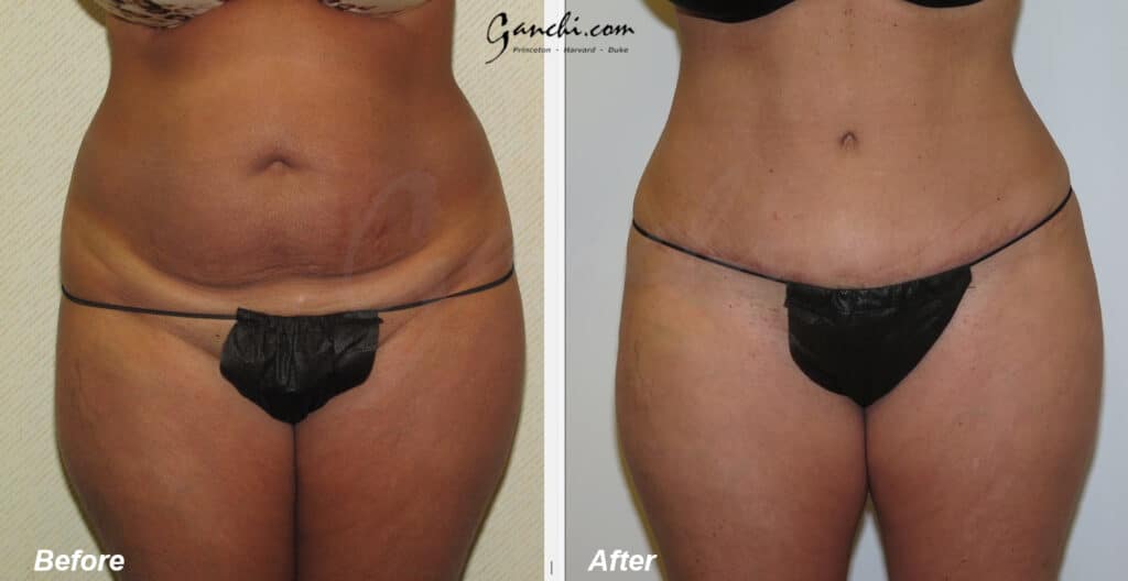 Tummy Tuck Before and After Photo by Ganchi Plastic Surgery in Northern New Jersey